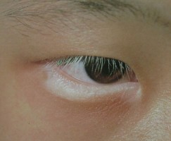 专家讲解:眼角白斑如何治疗