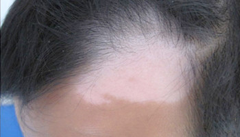 头皮白癜风做植皮治影响生发吗