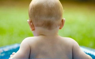 怎么判断婴幼儿早期白癜风症状
