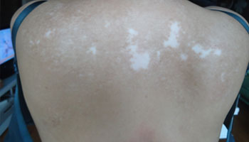 儿童后背的白斑激光多久能恢复正常