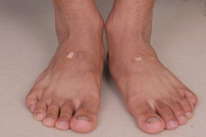 脚部白癜风患者要注意哪些护理