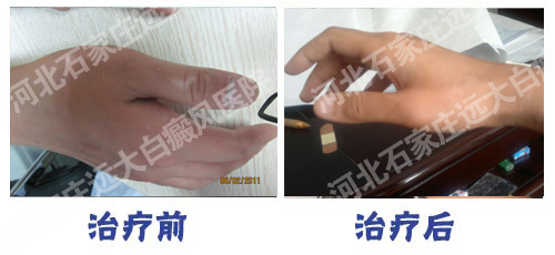 双手都患上了白癜风 这如何治疗呢?