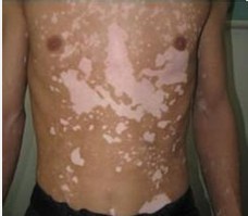 男性白癜风患者治疗方法