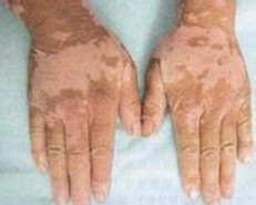 白癜风的心理治疗至关重要要重视吗？