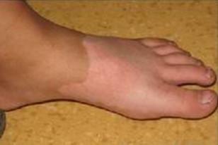 牙痛也会影响白癜风治疗！