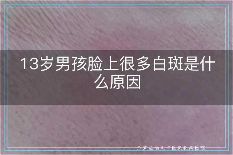 13岁男孩脸上很多白斑是什么原因