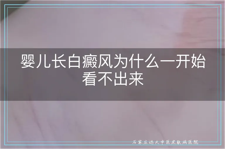 婴儿长白癜风为什么一开始看不出来