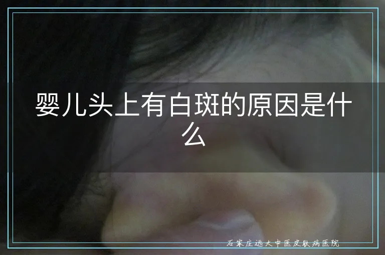 婴儿头上有白斑的原因是什么