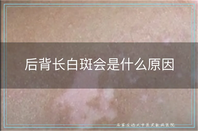 后背长白斑会是什么原因