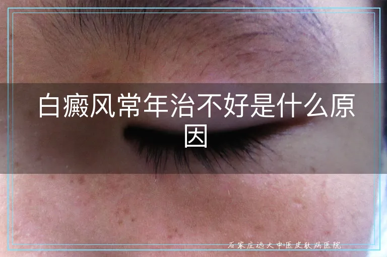 白癜风常年治不好是什么原因