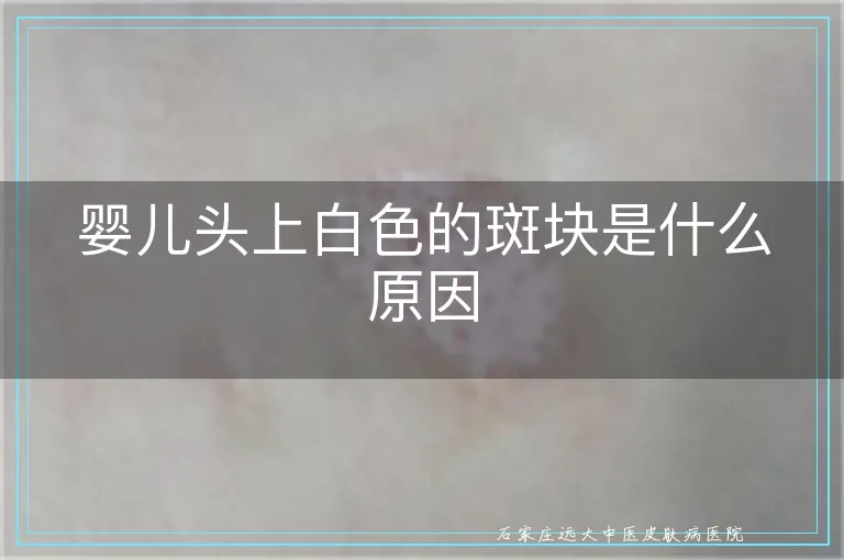 婴儿头上白色的斑块是什么原因