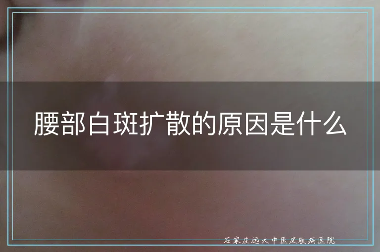 腰部白斑扩散的原因是什么