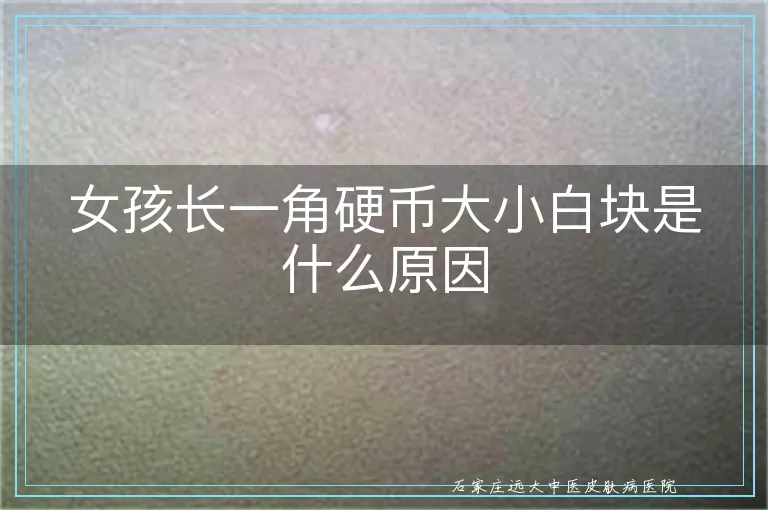 女孩长一角硬币大小白块是什么原因