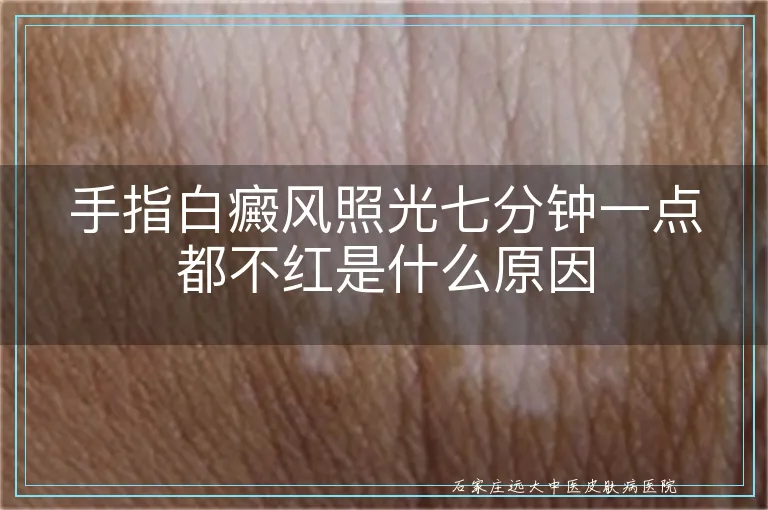 手指白癜风照光七分钟一点都不红是什么原因