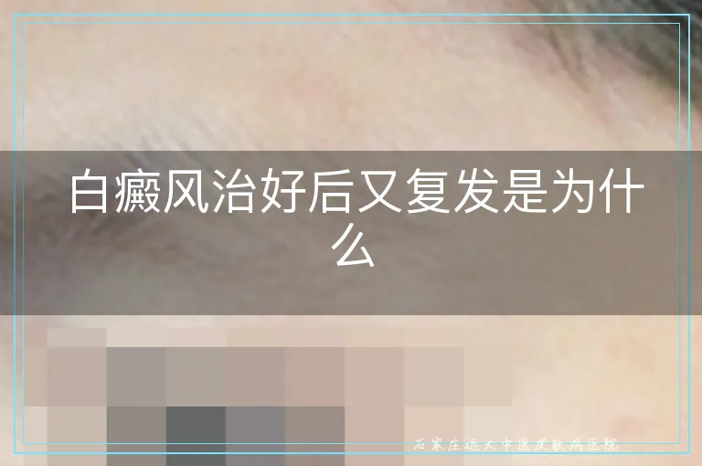 白癜风治好后又复发是为什么