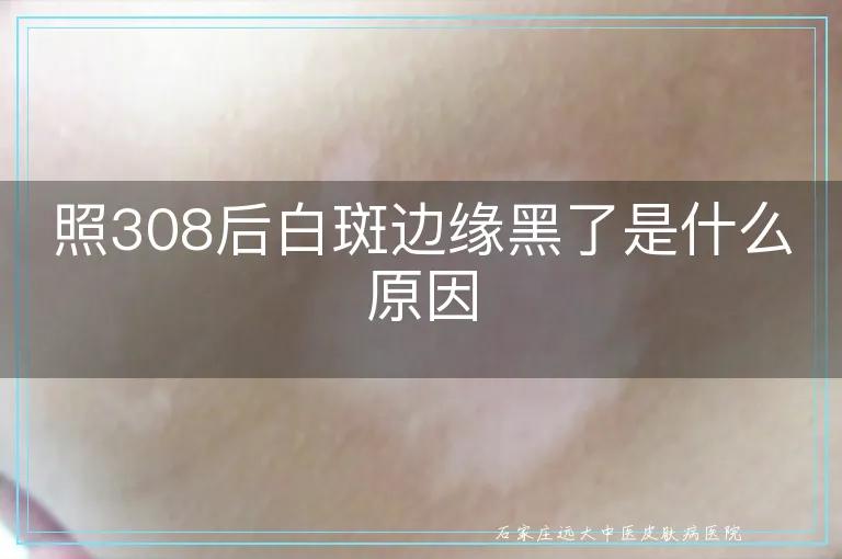 照308后白斑边缘黑了是什么原因