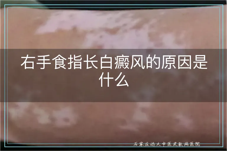 右手食指长白癜风的原因是什么