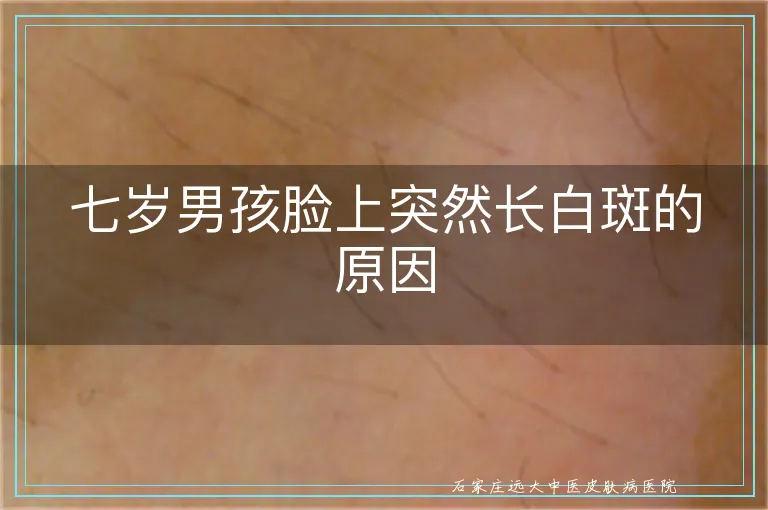 七岁男孩脸上突然长白斑的原因