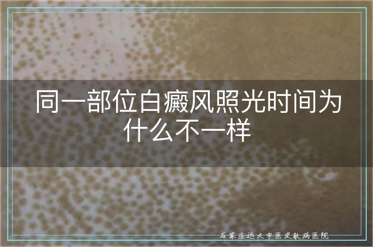 同一部位白癜风照光时间为什么不一样