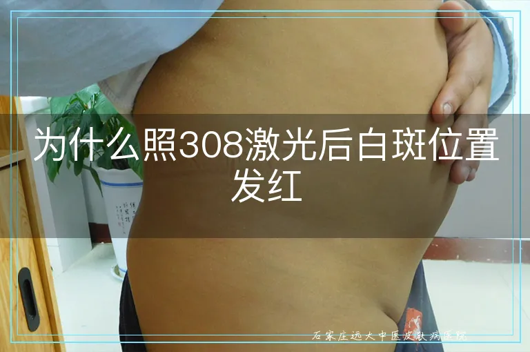 为什么照308激光后白斑位置发红