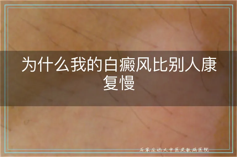 为什么我的白癜风比别人康复慢