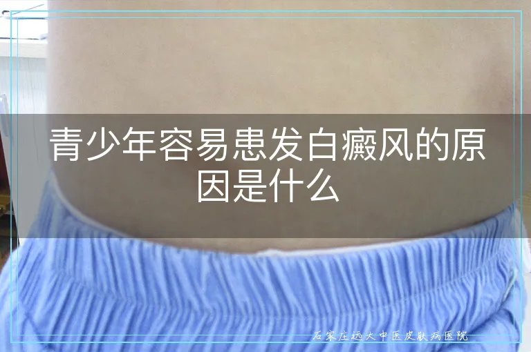 青少年容易患发白癜风的原因是什么