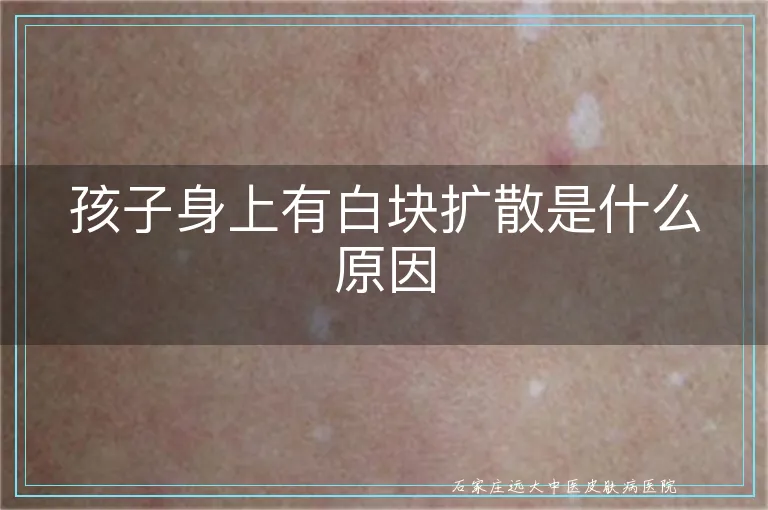 孩子身上有白块扩散是什么原因