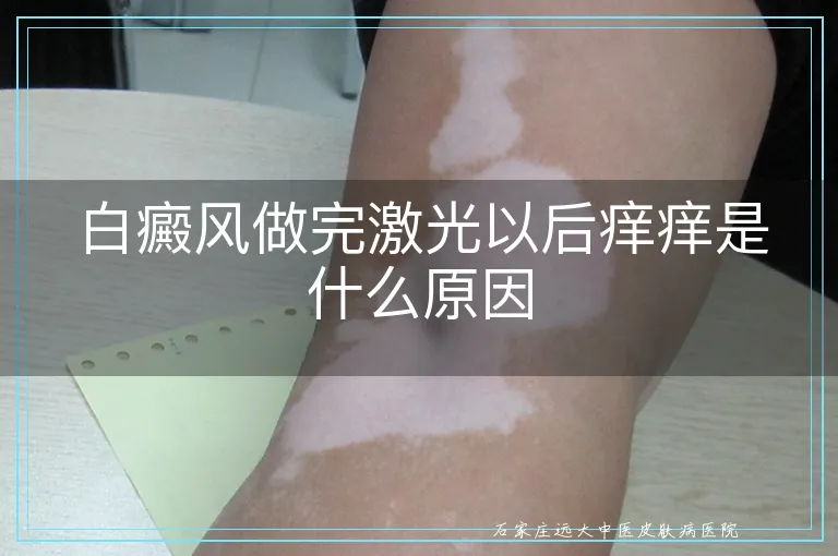 白癜风做完激光以后痒痒是什么原因