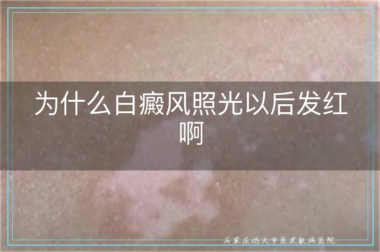 为什么白癜风照光以后发红啊