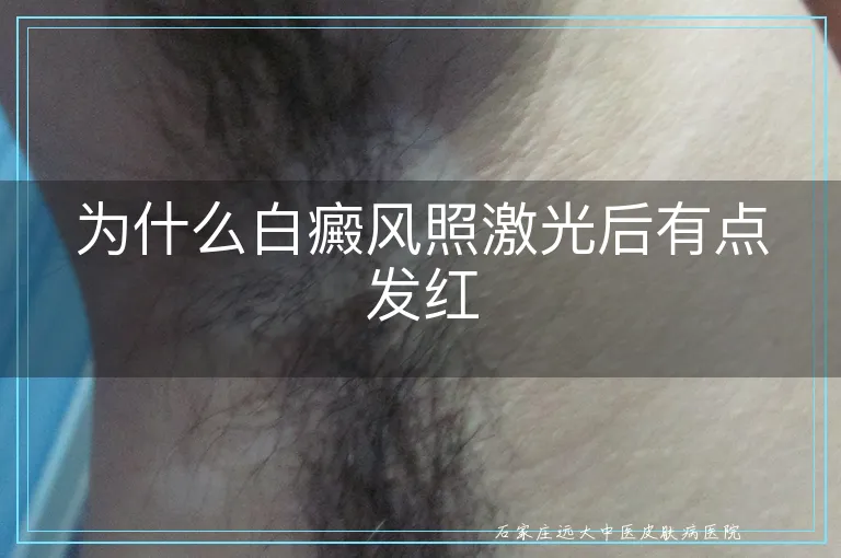 为什么白癜风照激光后有点发红