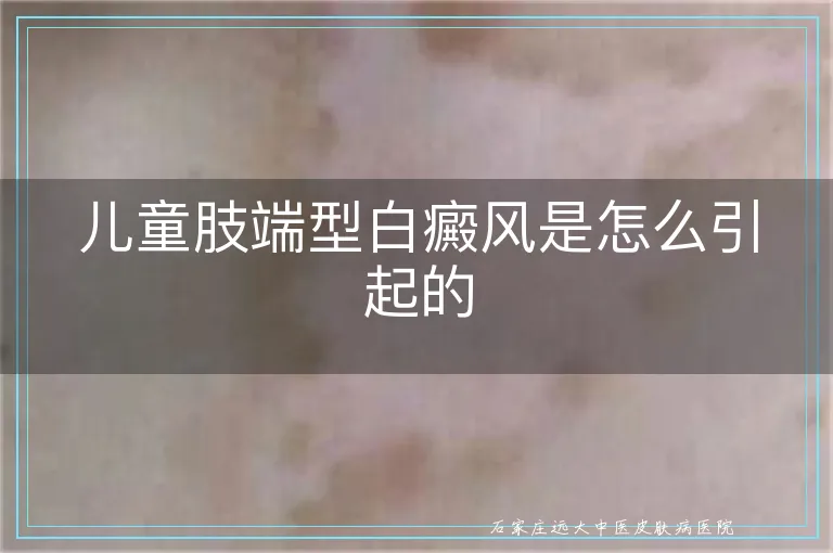 儿童肢端型白癜风是怎么引起的