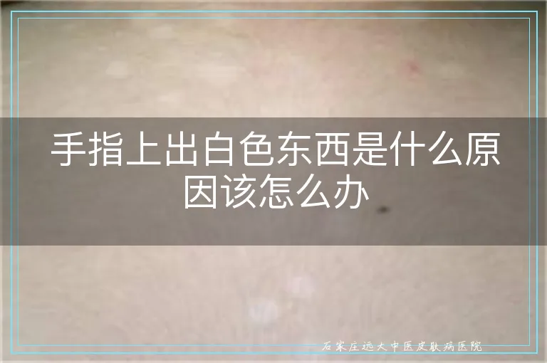 手指上出白色东西是什么原因该怎么办