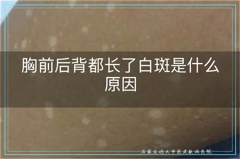 胸前后背都长了白斑是什么原因