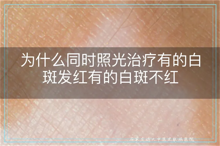 为什么同时照光治疗有的白斑发红有的白斑不红