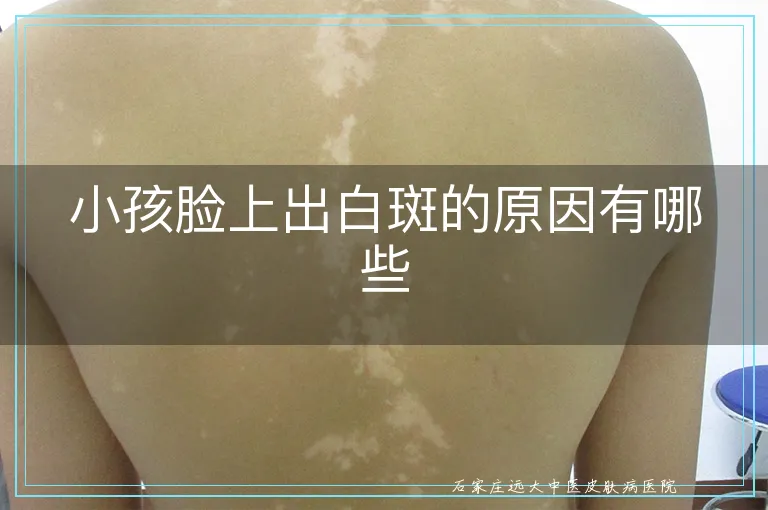 小孩脸上出白斑的原因有哪些