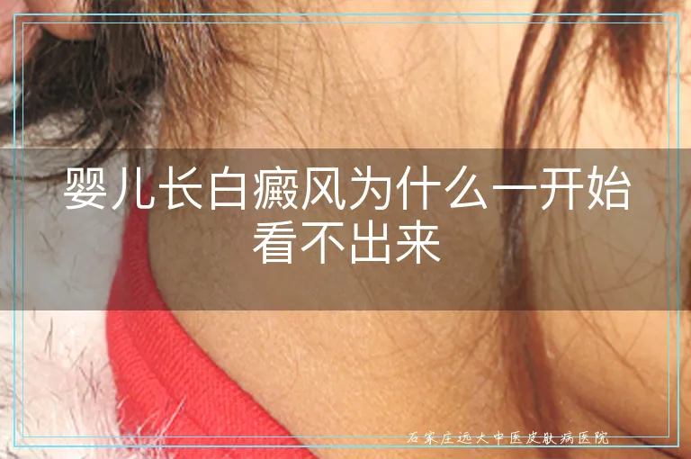 婴儿长白癜风为什么一开始看不出来