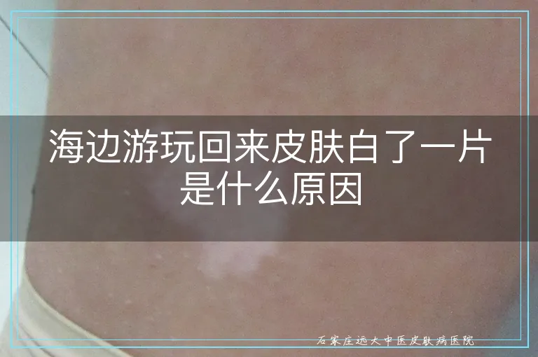 海边游玩回来皮肤白了一片是什么原因