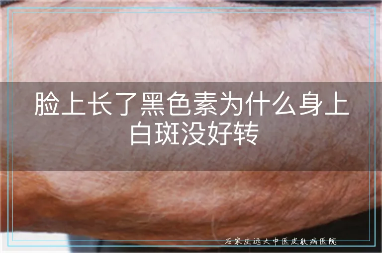 脸上长了黑色素为什么身上白斑没好转