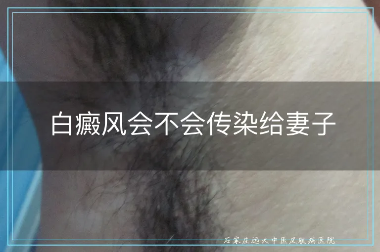 白癜风会不会传染给妻子
