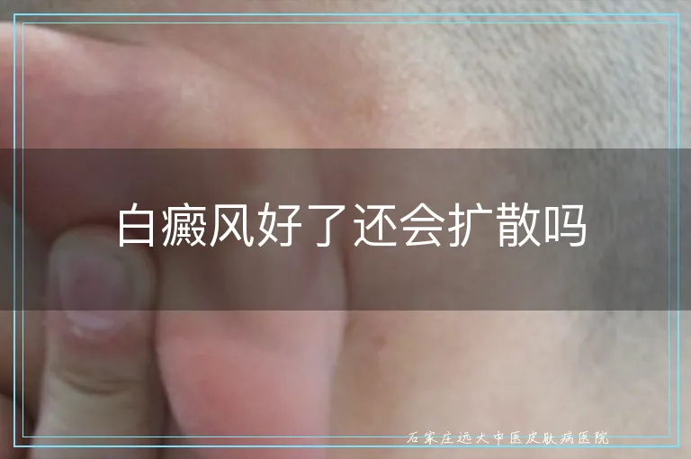 白癜风好了还会扩散吗