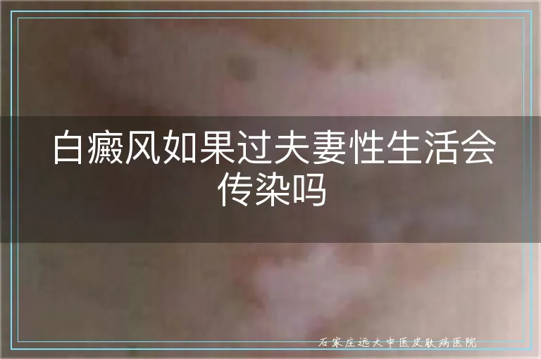 白癜风如果过夫妻性生活会传染吗