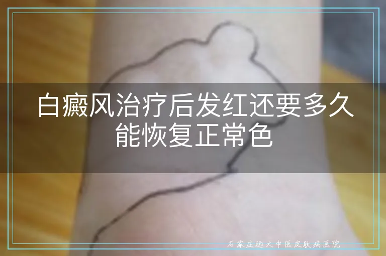 白癜风治疗后发红还要多久能恢复正常色