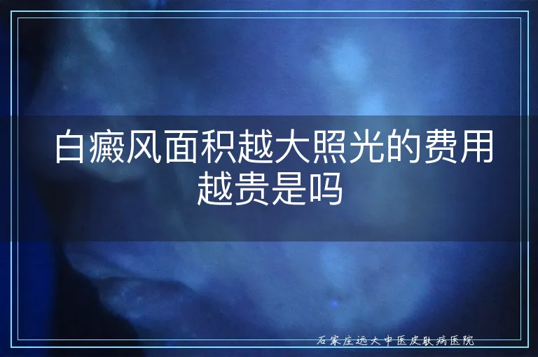 白癜风面积越大照光的费用越贵是吗