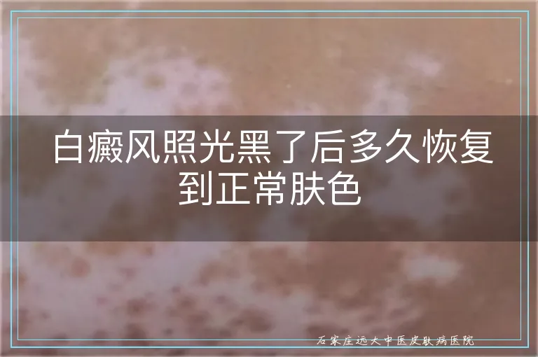 白癜风照光黑了后多久恢复到正常肤色