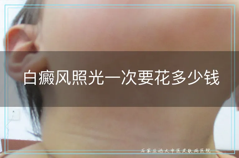 白癜风照光一次要花多少钱