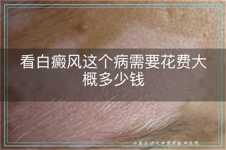 看白癜风这个病需要花费大概多少钱