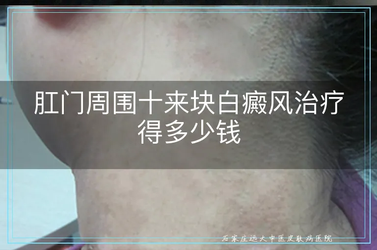 肛门周围十来块白癜风治疗得多少钱