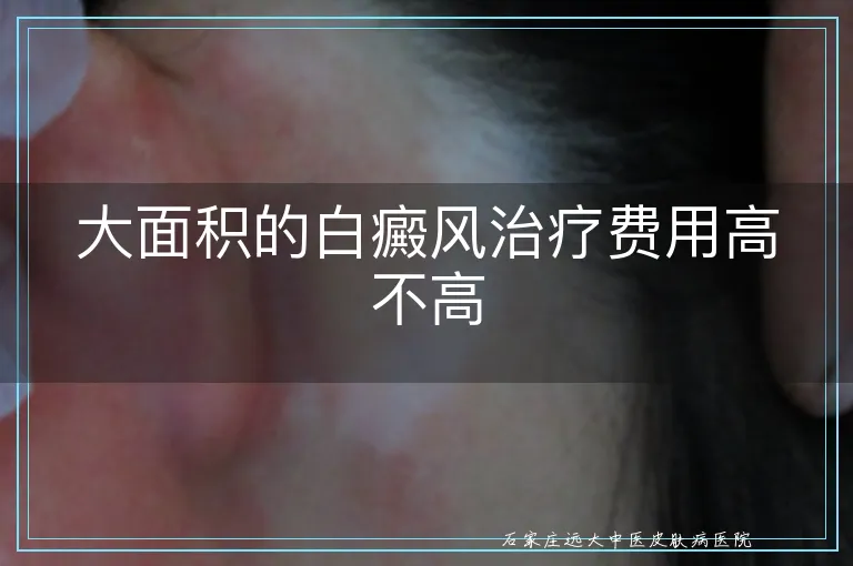 大面积的白癜风治疗费用高不高