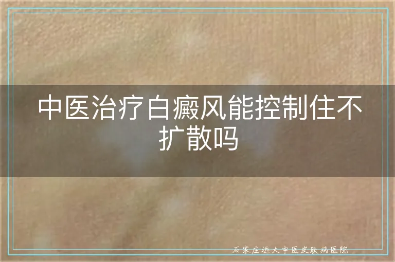 中医治疗白癜风能控制住不扩散吗