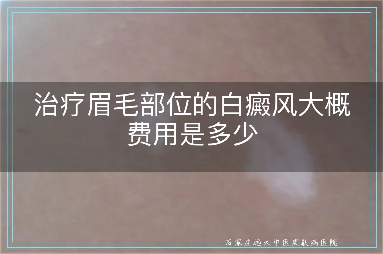 治疗眉毛部位的白癜风大概费用是多少